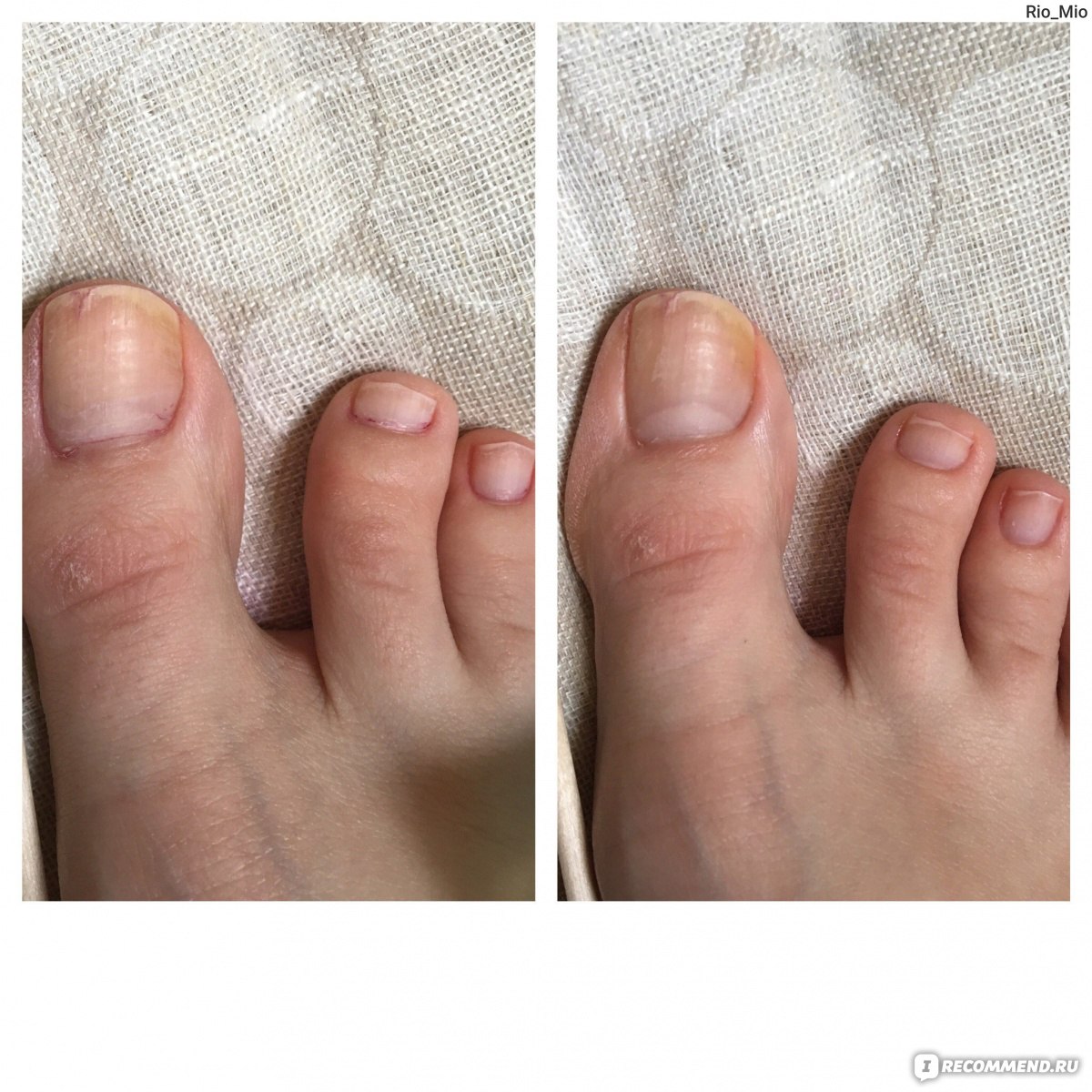Педикюр до и после. Женский педикюр до и после. Педикюр без покрытия до и после. Педикюр на проблемных ногтях.