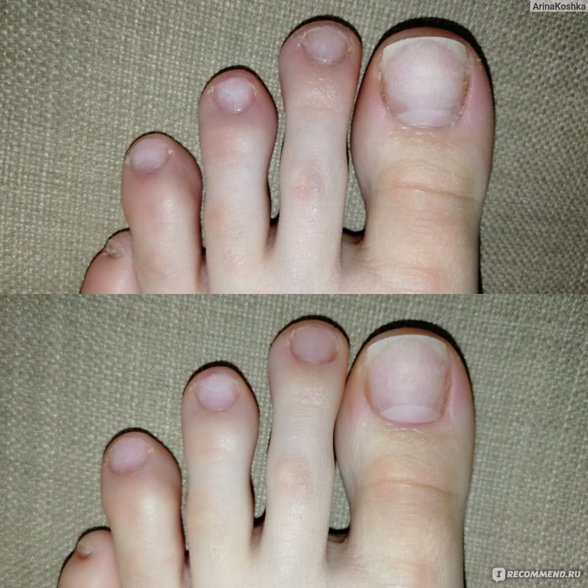 Педикюр до и после. Ногти после педикюра без покрытия. Мужской педикюр до и после. Ногти до и после педикюра.